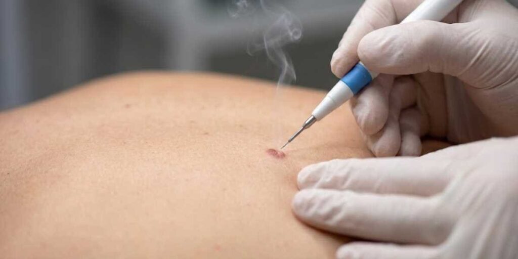 Procedimento dermatológico com cauterização de lesão cutânea, garantindo tratamento seguro e especializado da pele.
