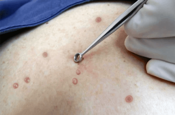 Procedimento dermatológico para remoção de lesões cutâneas, com avaliação e tratamento especializado da pele.