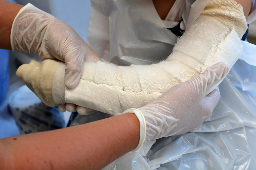 Imobilização ortopédica com gesso para tratamento e recuperação segura de fraturas.